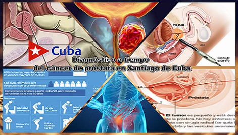 Se puede diagnosticar a tiempo el cáncer de próstata en Santiago de Cuba